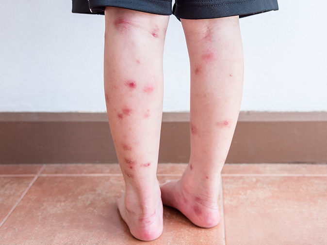 child from maine with bug bites all over their legs from playing outside