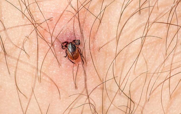 a tick embedded in human skin