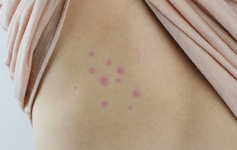 bed bug bites on human skin