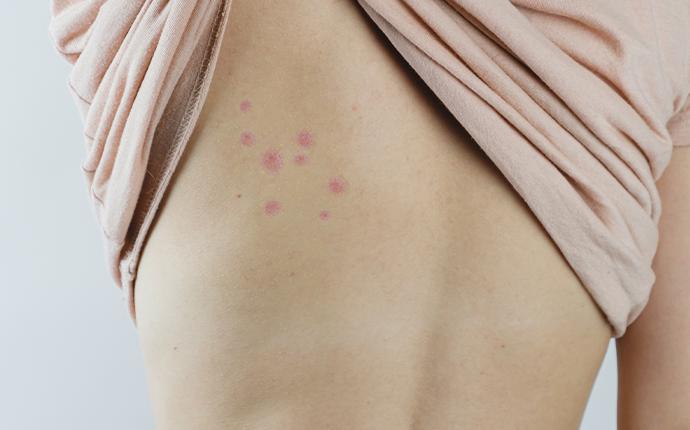 red bites on a persons back