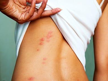 identifying bug bites on humans