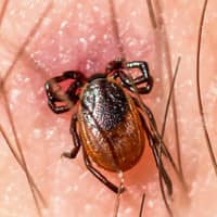 tick embedded in skin