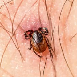 tick embedded in skin
