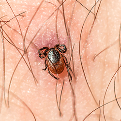 tick embedded in springfield resident