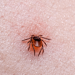 tick embedded in skin