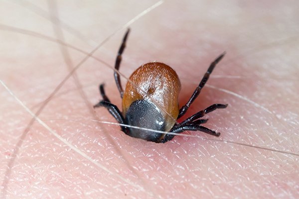 a tick embedded in human skin in pennsylvania