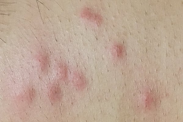 bed bug bites on face and neck