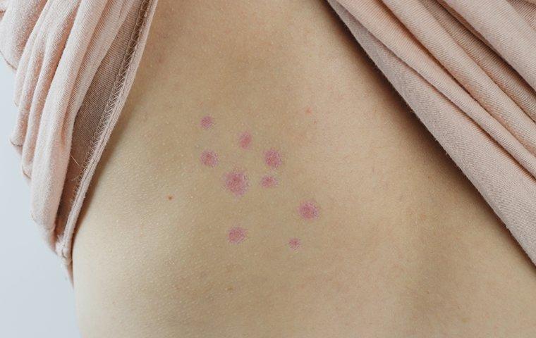 bed bug bites on a residents skin