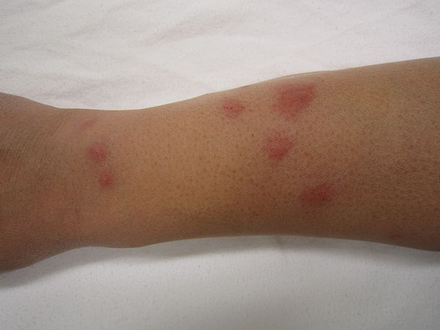 Bed Bug bites on person's arm