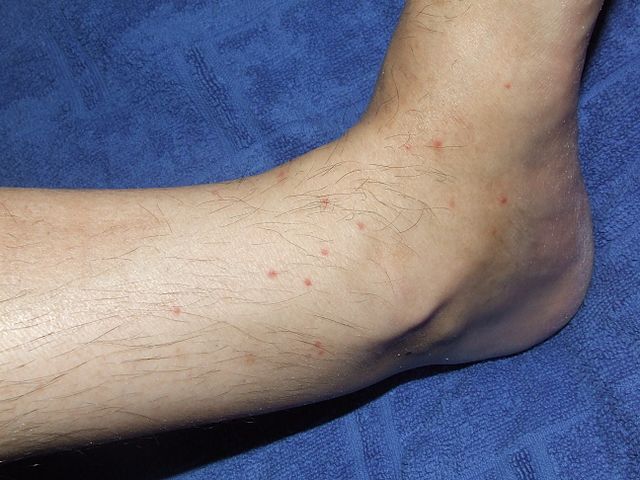 Flea bites on person's ankle