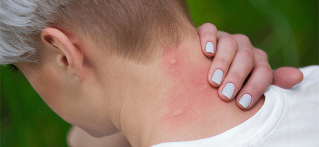 mosquito bite on neck