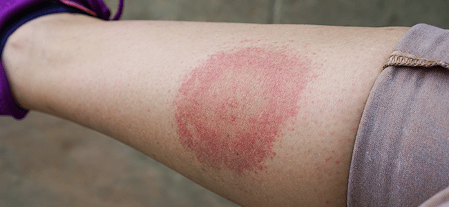 bulls eye rash from lyme disease