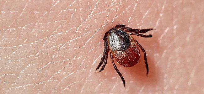 tick embedded into skin