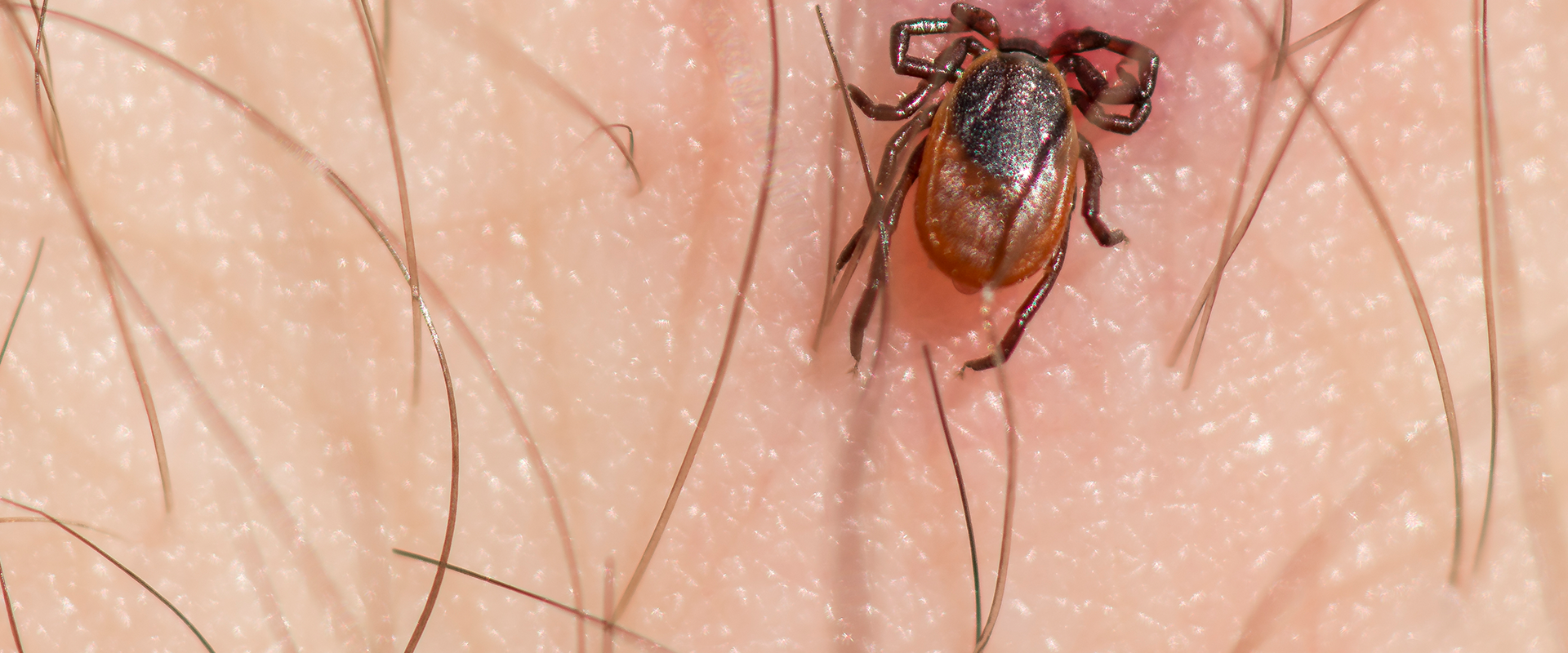 washington dc man with a tick in his stomach