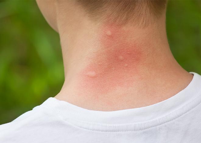 a persons neck covered in mosquito bites in virginia