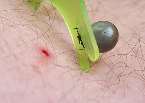 tick removed from skin