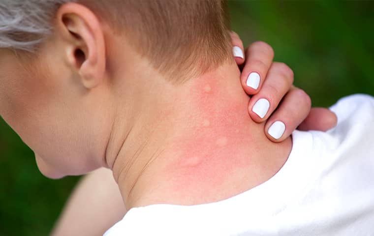 a woman in new jersey with bug bites on the back of her neck