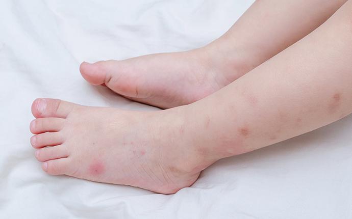 bed bug bites on a childs legs