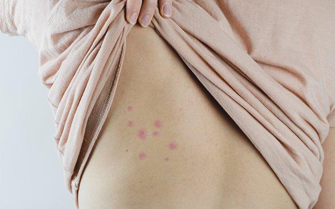 types of bug bites in bed