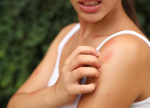 mosquito biting woman in summer