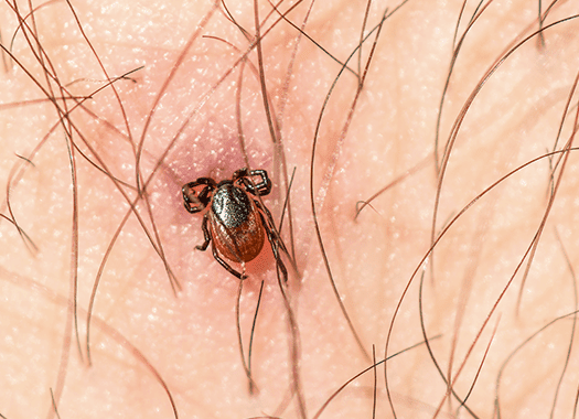 Learn How To Protect Your Family And Friends From Ticks tick embedded in skin of lexington resident