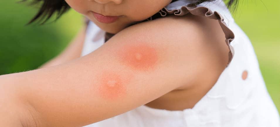 mosquito bites on arm of young girl