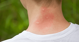 mosquito bites on a young jasper resident's neck