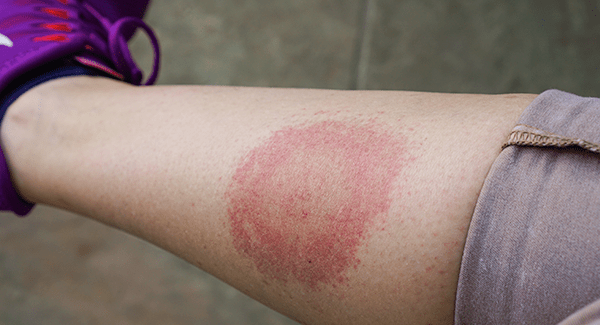 woman with lyme disease bullseye rash