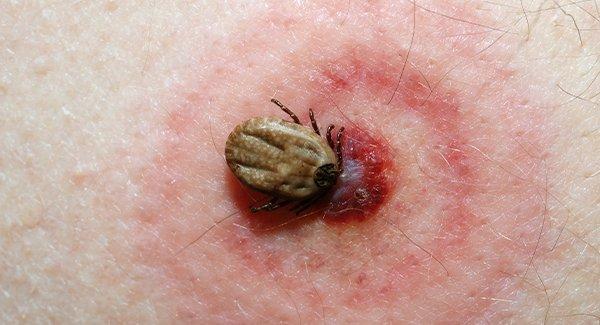 a tick biting and speading lime disease
