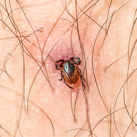 deer tick embedded in a maine man