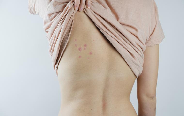 bed bug bites on a woman's back