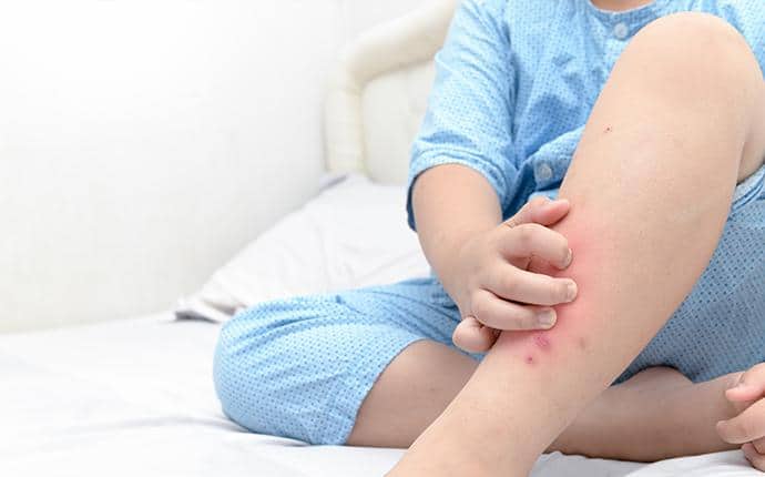 Effective Solutions For Bed Bug Infestations bed bug bites on central washington resident
