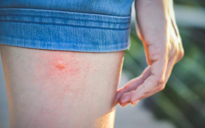 a red mosquito bite on a persons leg
