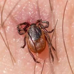 embedded tick in the skin