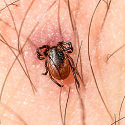 embedded tick in skin