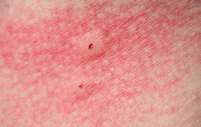 spider bites on skin