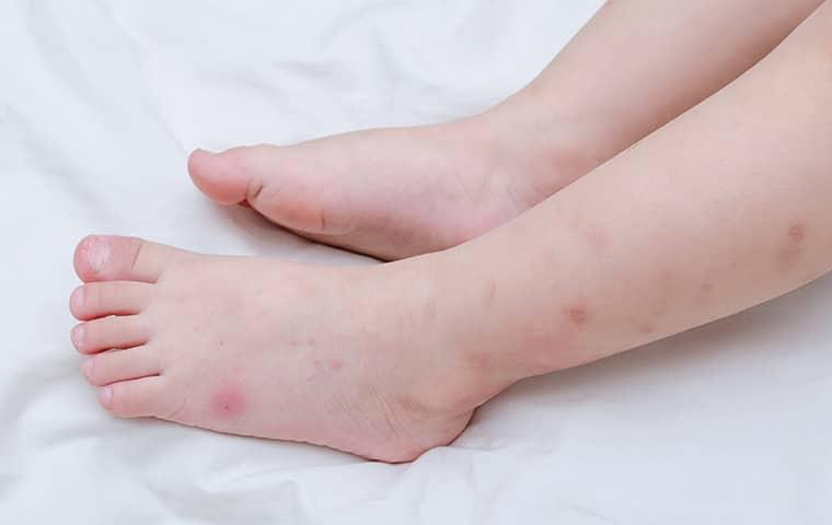 bed bug bites on childs leg