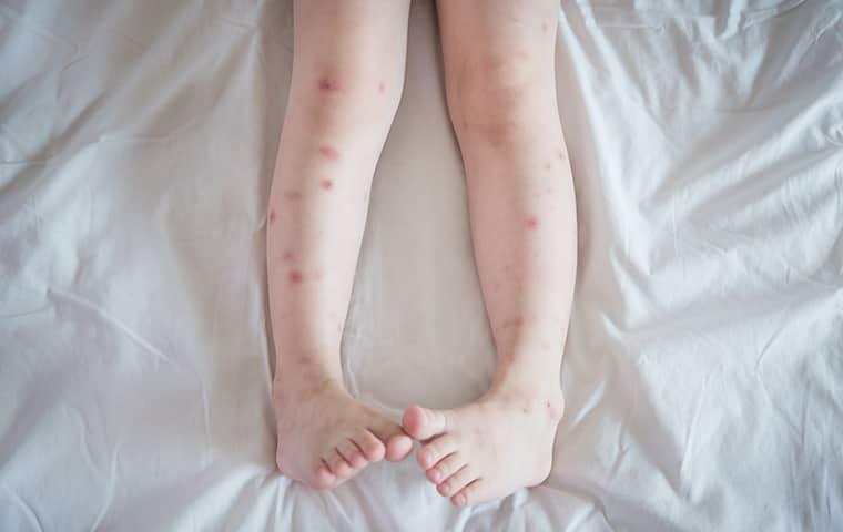 bed bug bites all over a childs legs