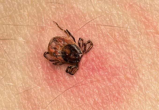 tick embedded in human skin 