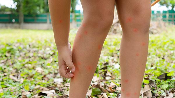 mosquito bites on childrens legs