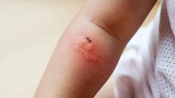 a mosquito bite on a childs arm